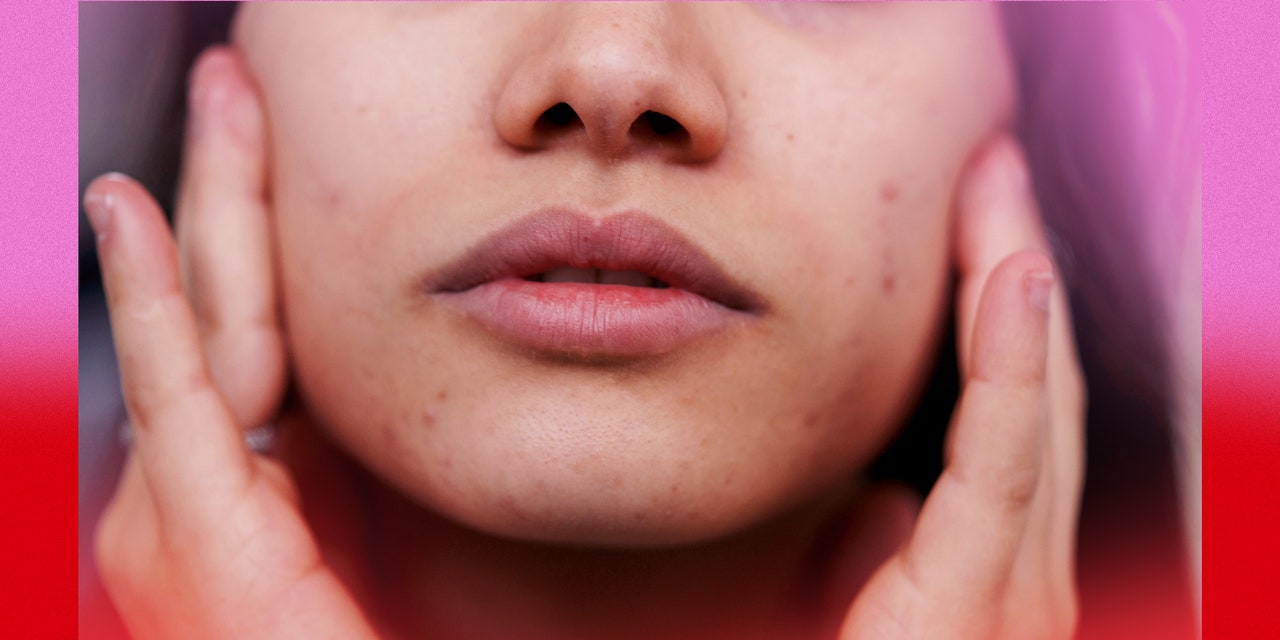 Here’s What PCOS Acne Looks Like—and How to Treat It