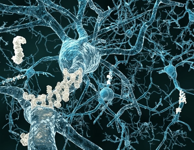 Study finds high levels of iron in the brains of people diagnosed with Down syndrome and Alzheimer’s