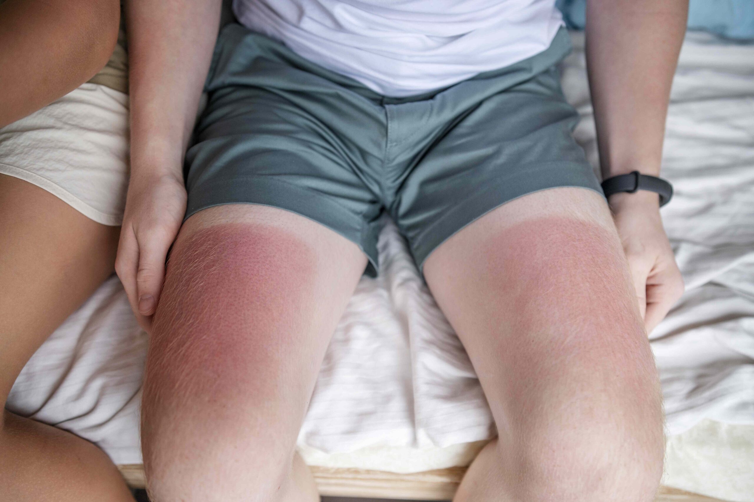 Sunburn vs. Sun Poisoning: Similarities and Differences