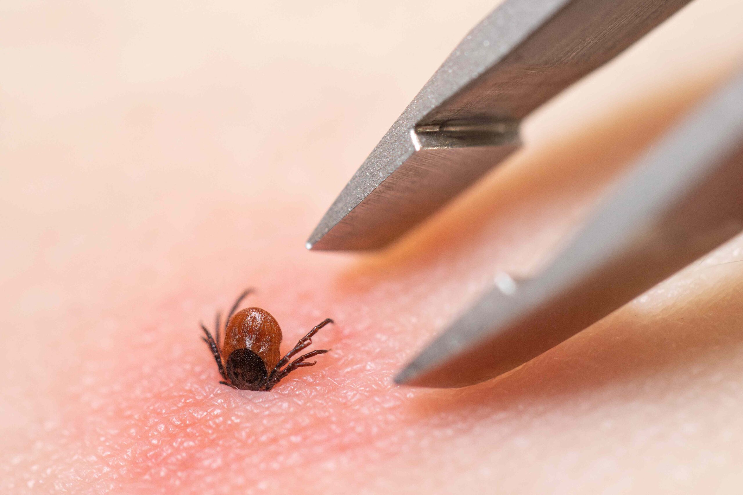 12 Spots on the Body Where You’re Most Likely to Find a Tick