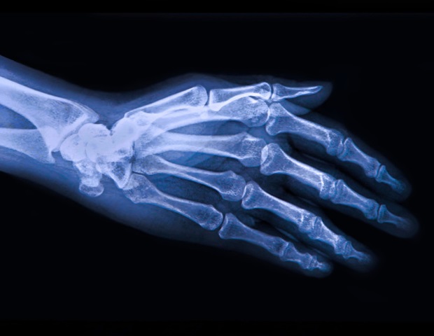 Osteoarthritis treatment in practice falls short of EULAR guidelines