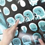 Treating Hashimoto’s Disease (Hypothyroidism) Naturally with Diet 