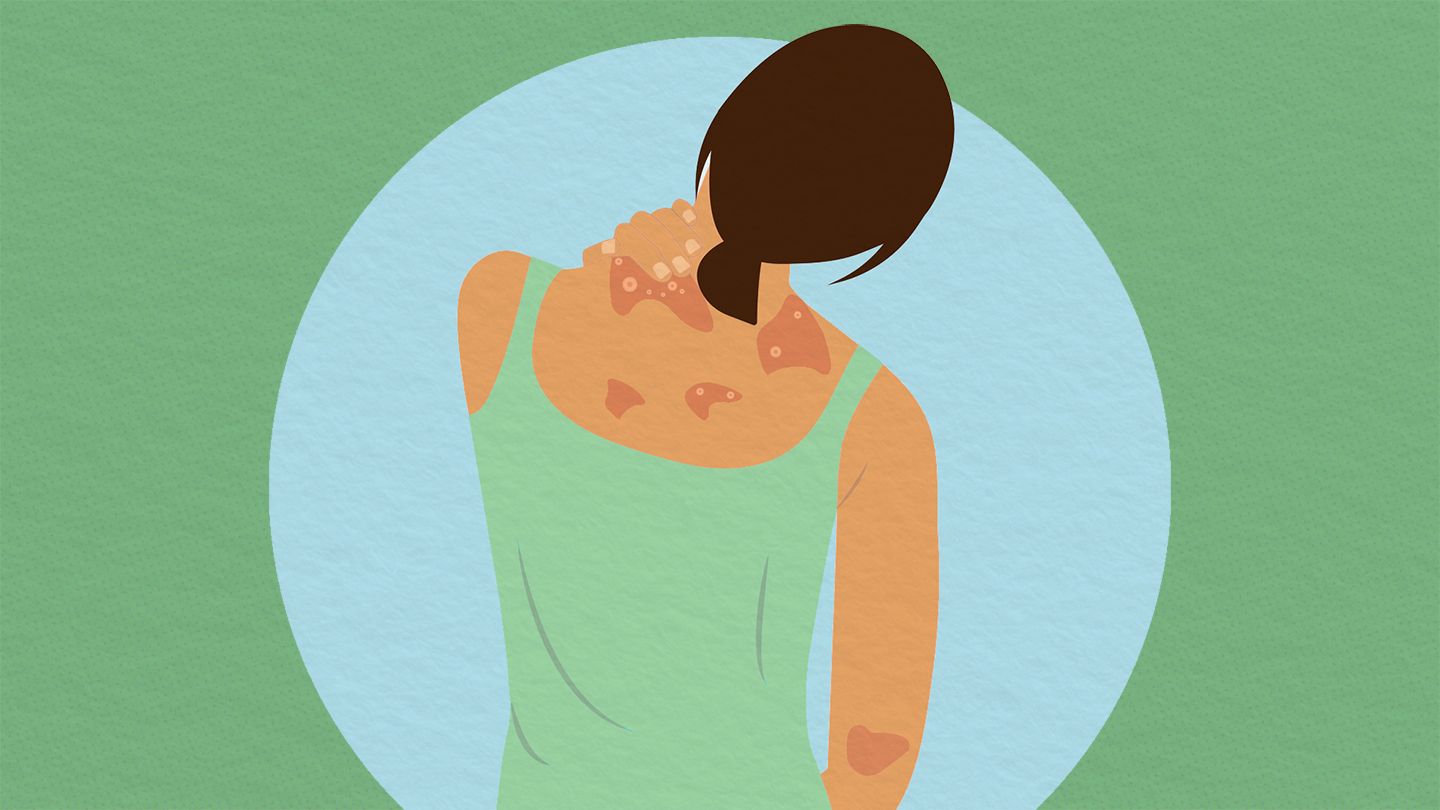 Managing Skin Cracks and Bleeding