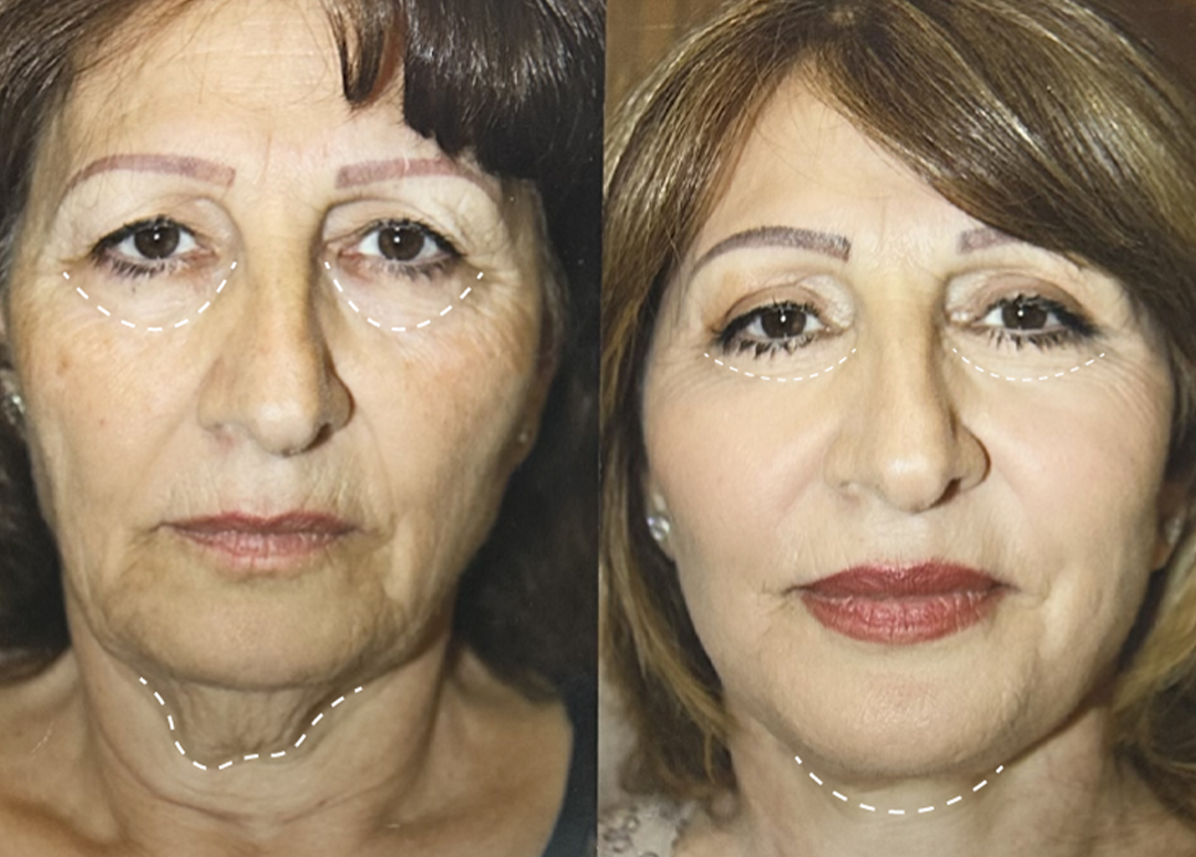 Dr. Chobanian’s Approach to Facial Harmony
