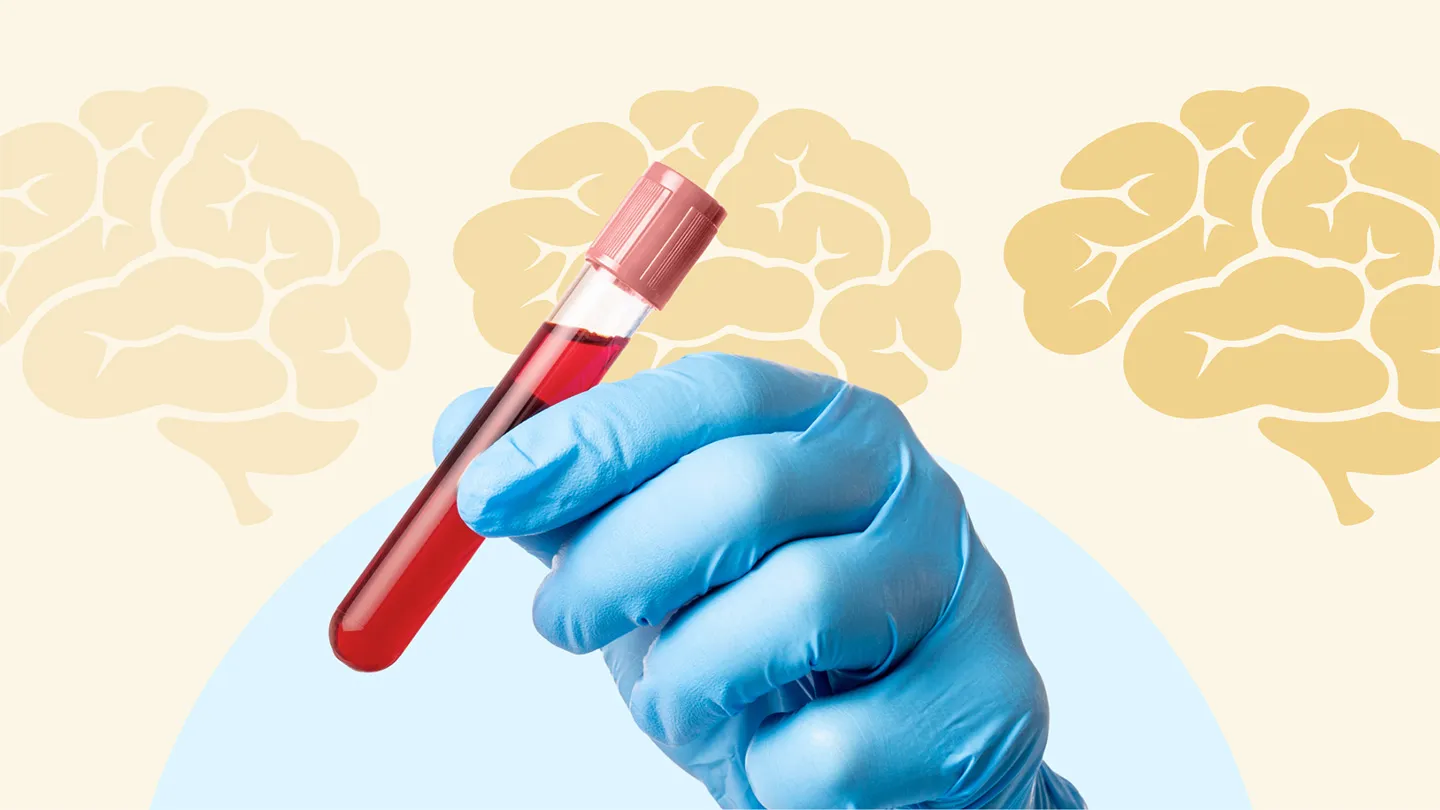 Blood Test May Predict Speed of Alzheimer’s Progression