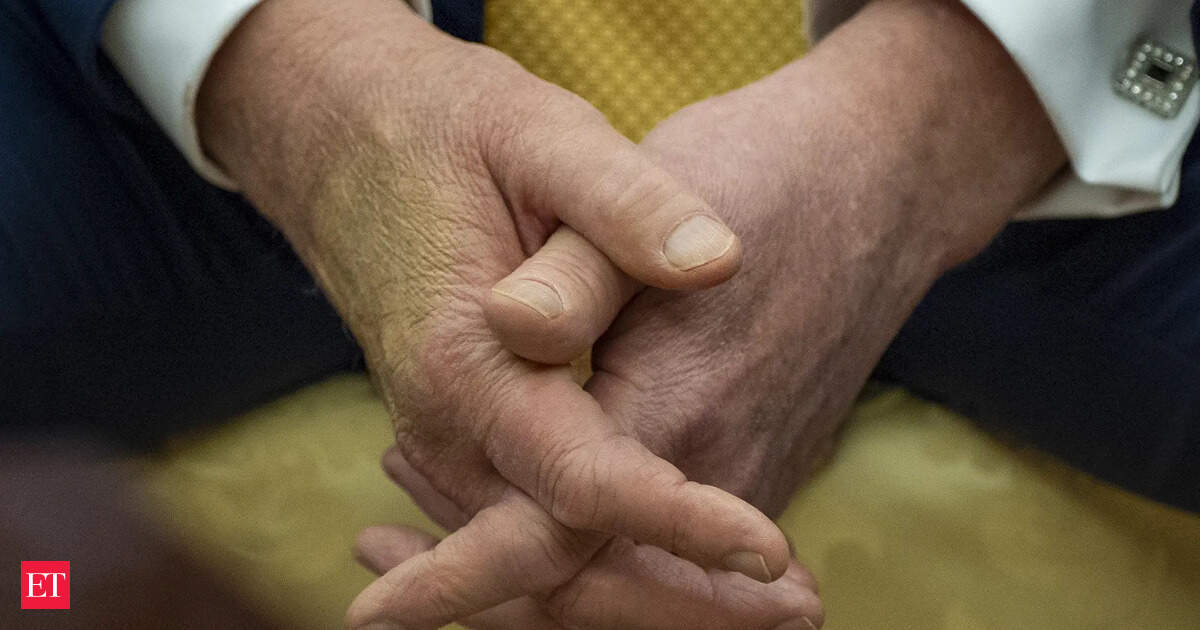 Chronic venous insufficiency: Trump diagnosed with chronic venous insufficiency after swelling in hands, legs. What is CVI and is it life-threatening?