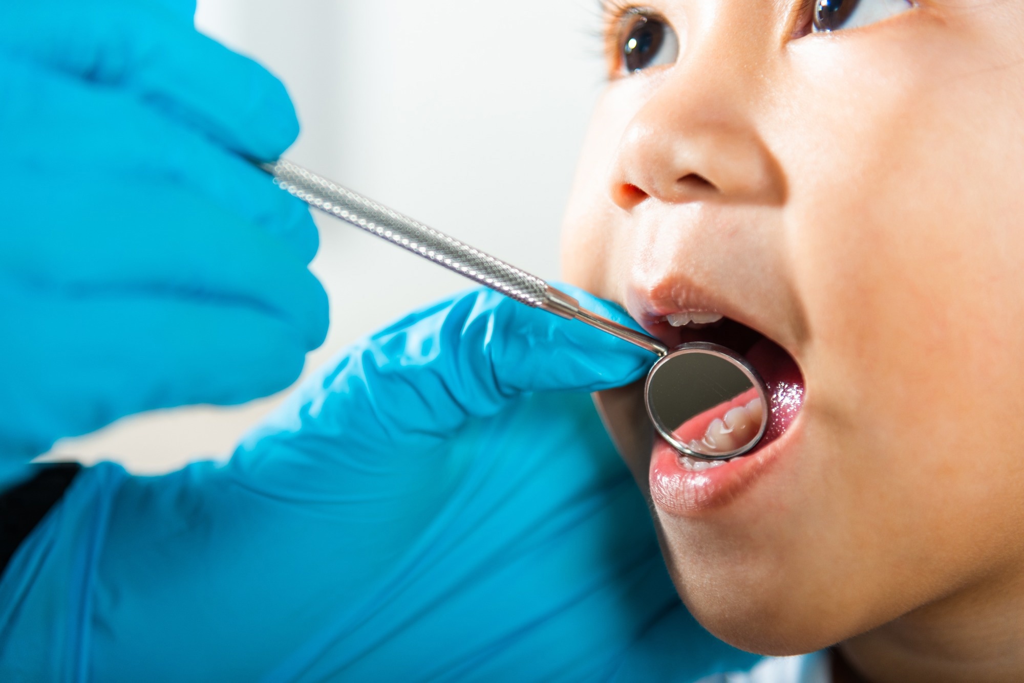 Even healthy eating can’t guarantee cavity-free kids, study reports