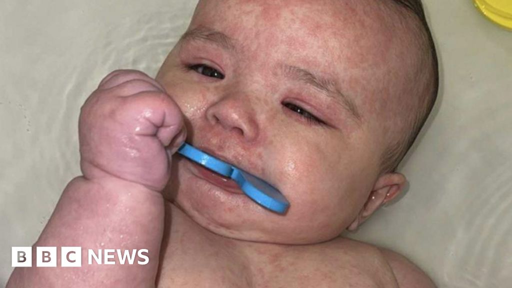 How Canada became the center of a measles outbreak in North America