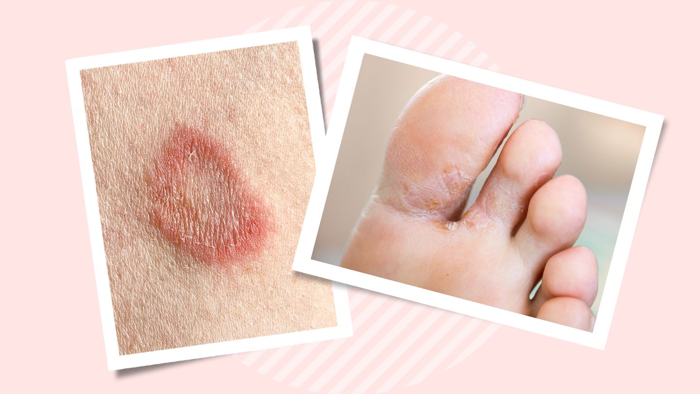 Symptoms, Causes, Diagnosis, Treatment, and Prevention